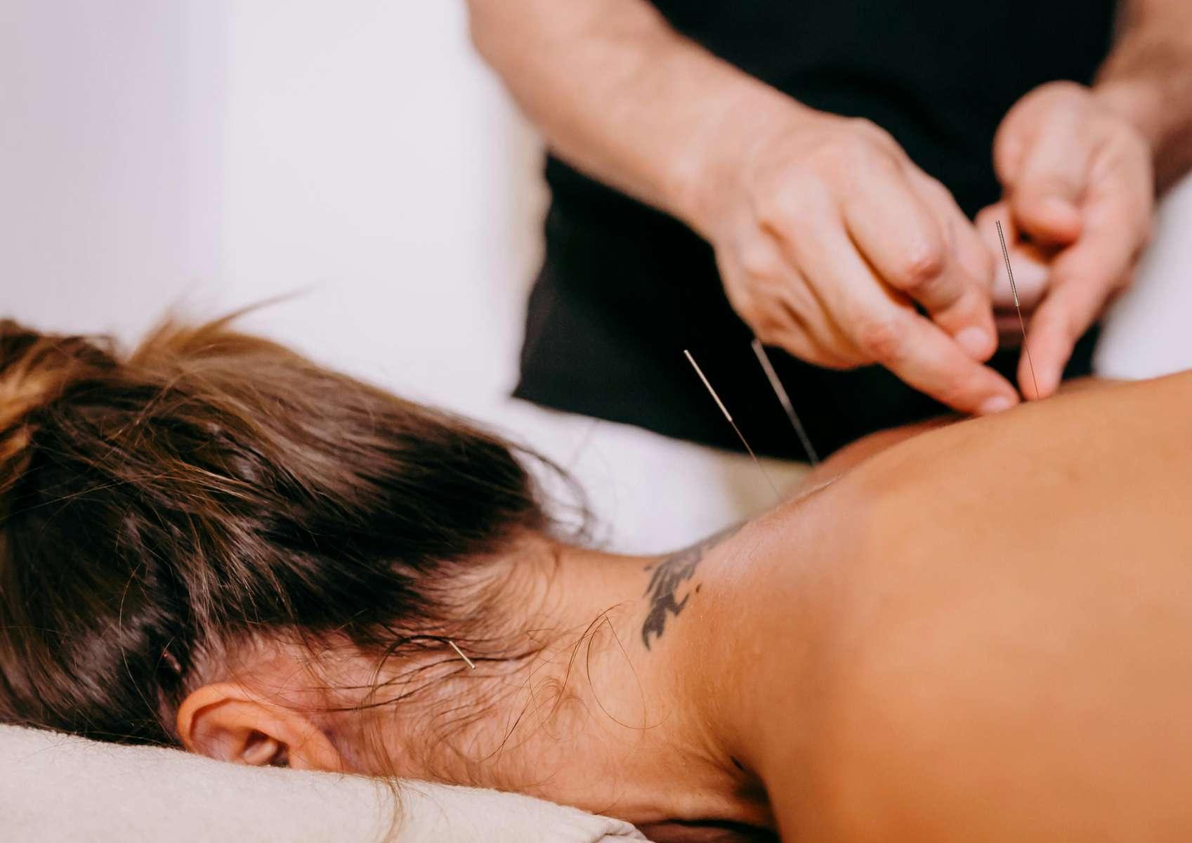 Femme allongée sur le ventre avec des aiguilles d'acupuncture dans le haut du dos